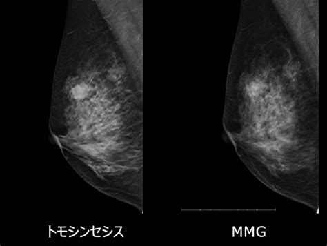 微細石灰化の集簇|乳房トモシンセシスにお け 集簇性石灰化症例の検討